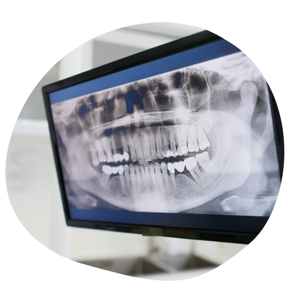 Dental panorex xray Dental panorex.